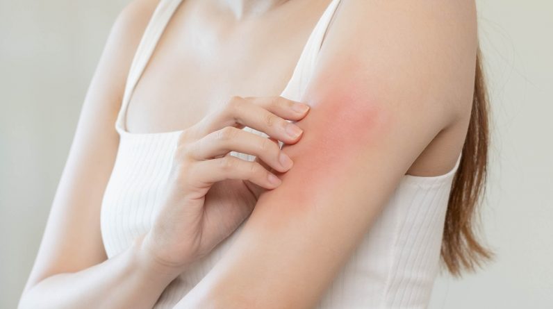 7 Foods To Eat And 7 To Avoid For Eczema - Health Digest